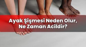 Ayak Şişmesi Neden Olur, Ne Zaman Acildir?