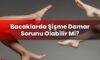Bacaklarda Şişme Damar Sorunu Olabilir Mi?