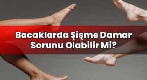Bacaklarda Şişme Damar Sorunu Olabilir Mi?