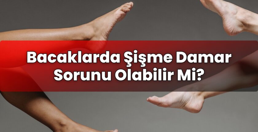 Bacaklarda Şişme Damar Sorunu Olabilir Mi?