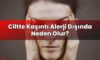 Ciltte Kaşıntı Alerji Dışında Neden Olur?
