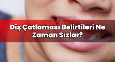 Diş Çatlaması Belirtileri Ne Zaman Sızlar?