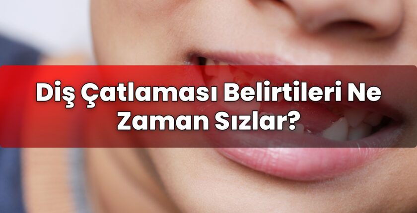 Diş Çatlaması Belirtileri Ne Zaman Sızlar?