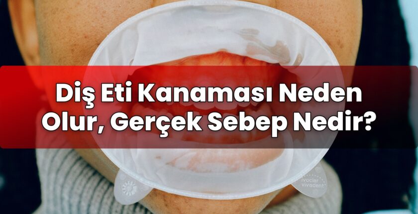 Diş Eti Kanaması Neden Olur, Gerçek Sebep Nedir?