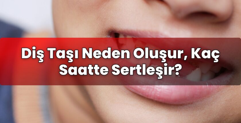 Diş Taşı Neden Oluşur, Kaç Saatte Sertleşir?