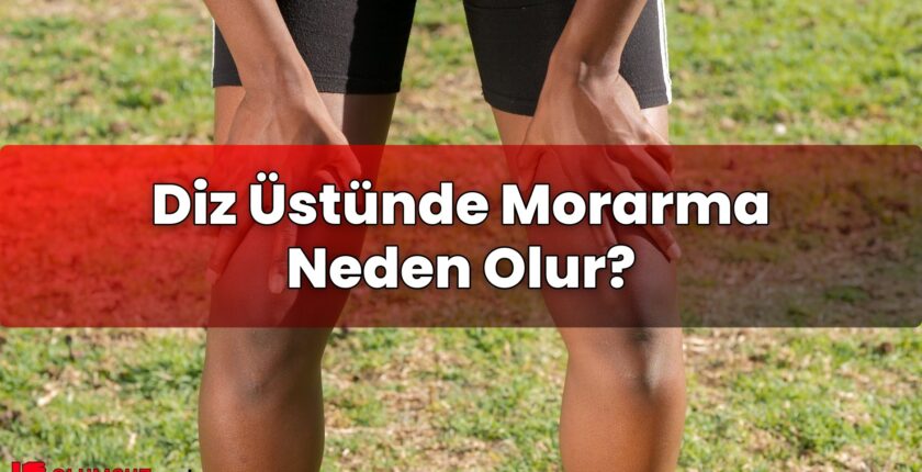 Diz Üstünde Morarma Neden Olur?