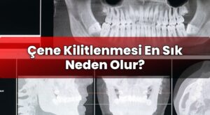 Çene Kilitlenmesi En Sık Neden Olur?