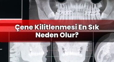 Çene Kilitlenmesi En Sık Neden Olur?