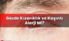 Gözde Kızarıklık ve Kaşıntı Alerji Mi?