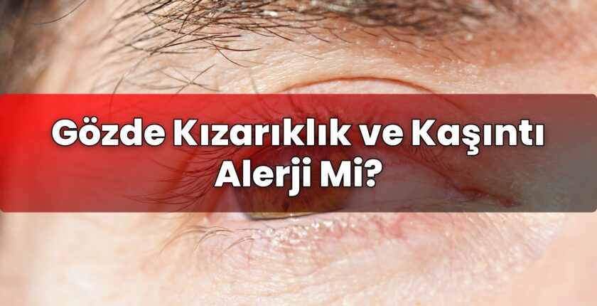 Gözde Kızarıklık ve Kaşıntı Alerji Mi?