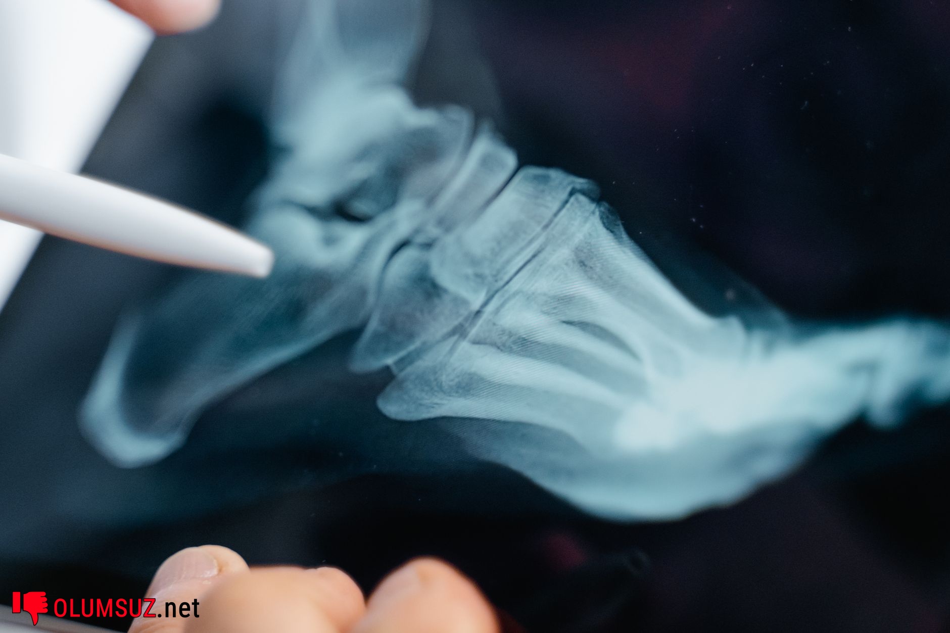 Osteoporoz riski olan kadın, kırılgan kemik vurgusu