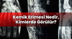 Kemik Erimesi Nedir, Kimlerde Görülür?