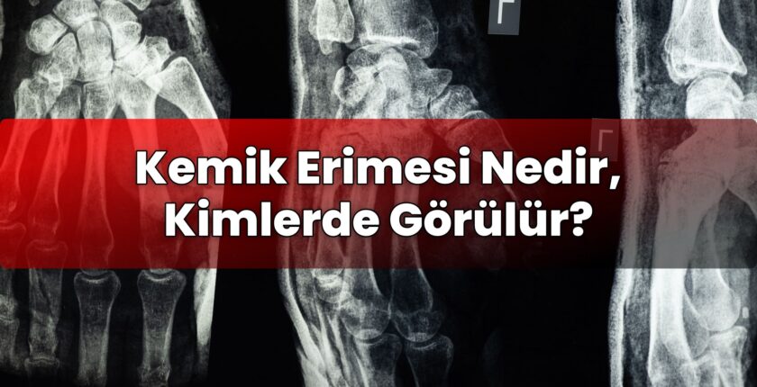 Kemik Erimesi Nedir, Kimlerde Görülür?